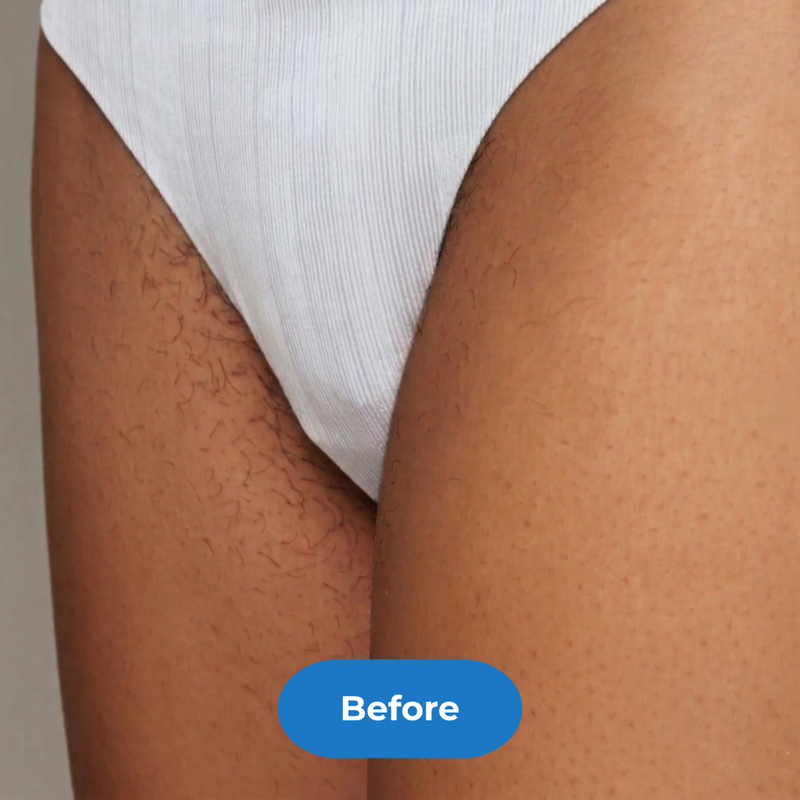 Bikini before treatment