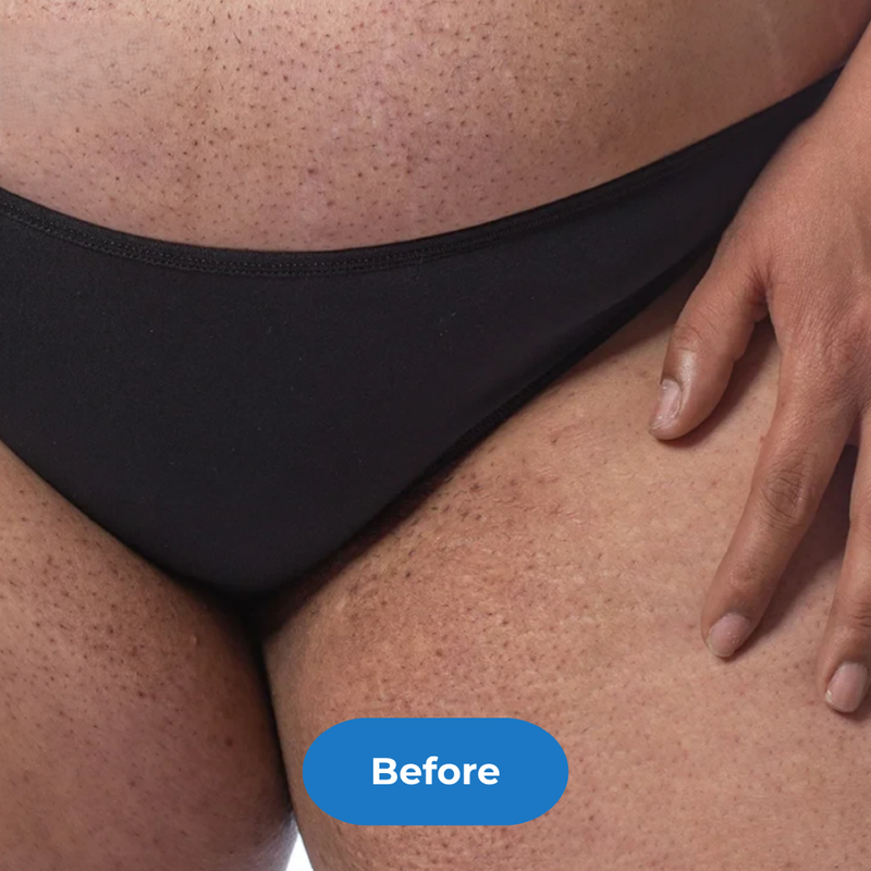 Bikini before treatment