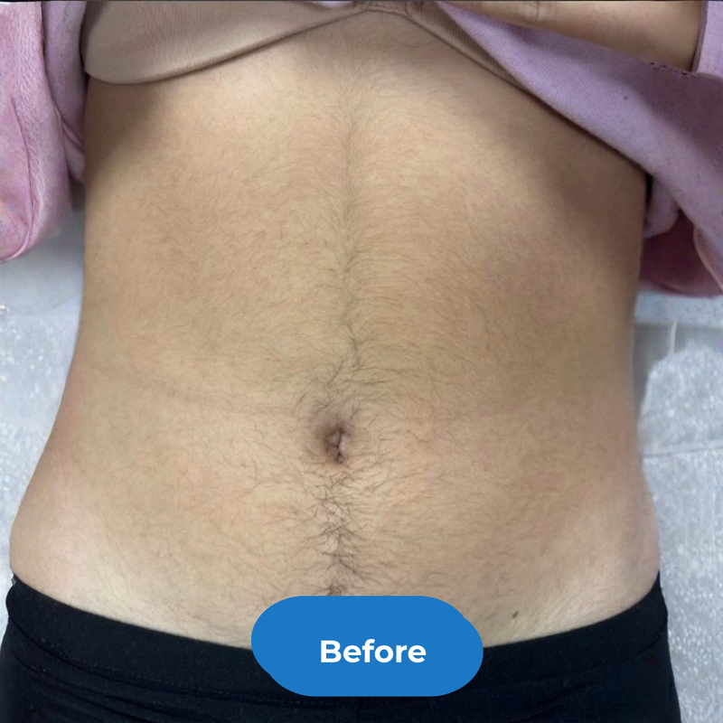 Stomach before treatment