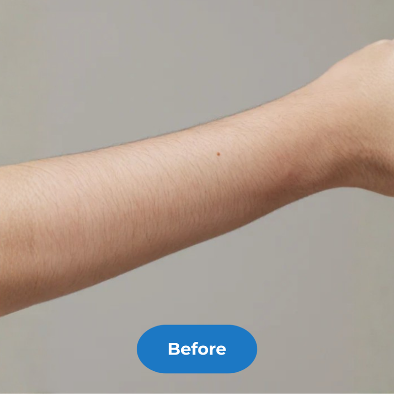 Arms before treatment