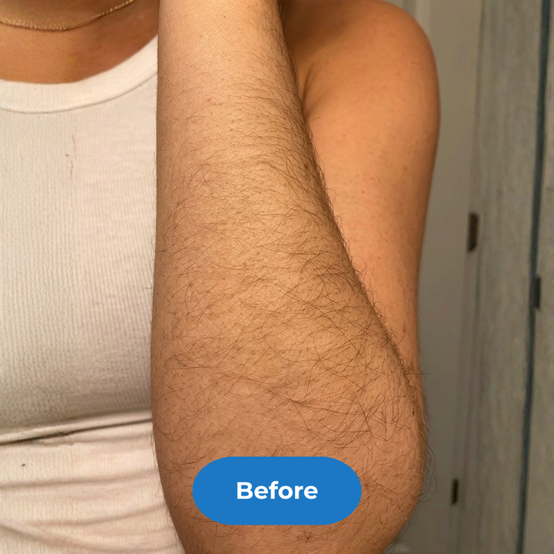 Arms before treatment