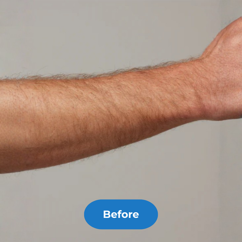 Arms before treatment
