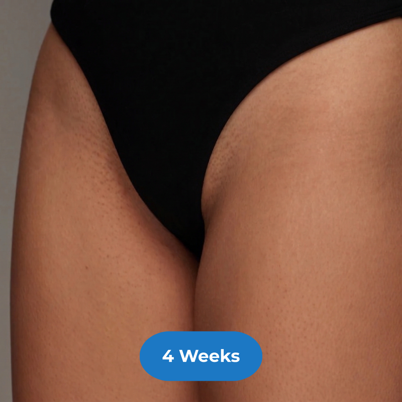 Bikini after treatment