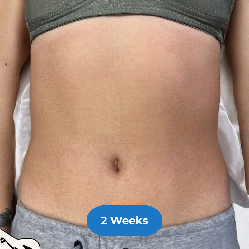 Stomach after treatment