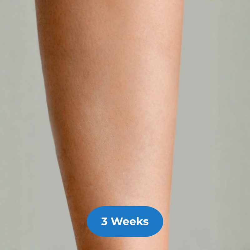 Legs after treatment
