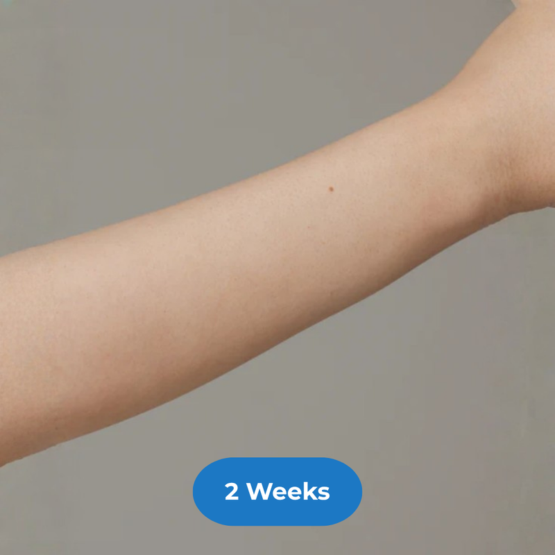 Arms after treatment