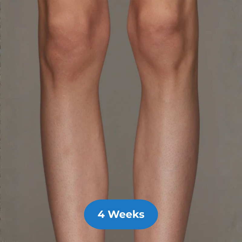 Legs after treatment