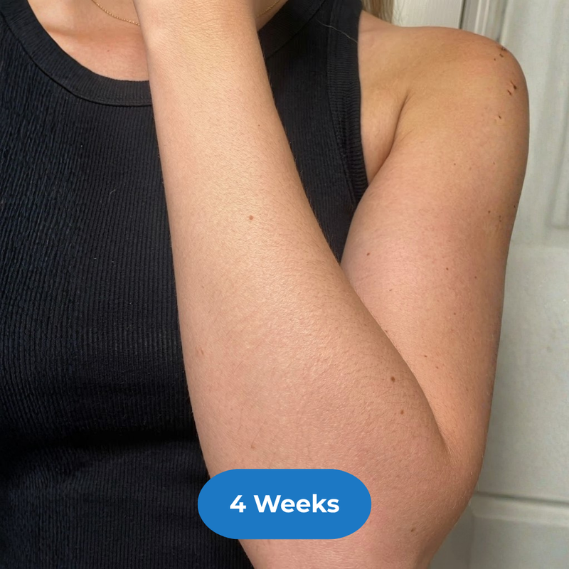 Arms after treatment