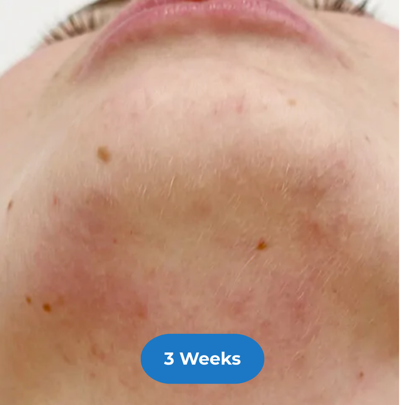 Face after treatment