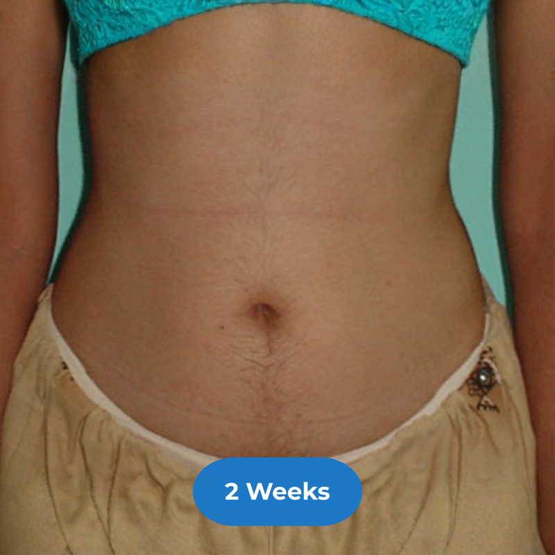 Stomach after treatment