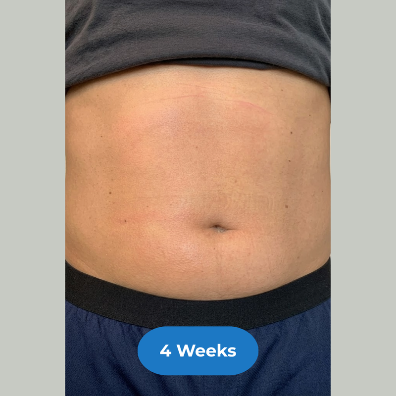 Stomach after treatment