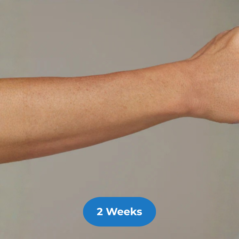 Arms after treatment