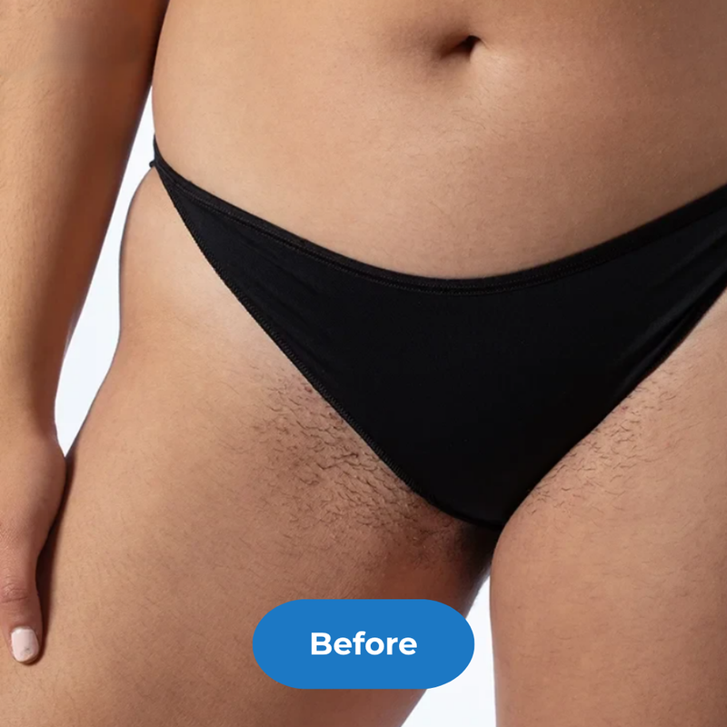 Bikini before treatment