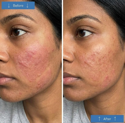FirmFace Mask™