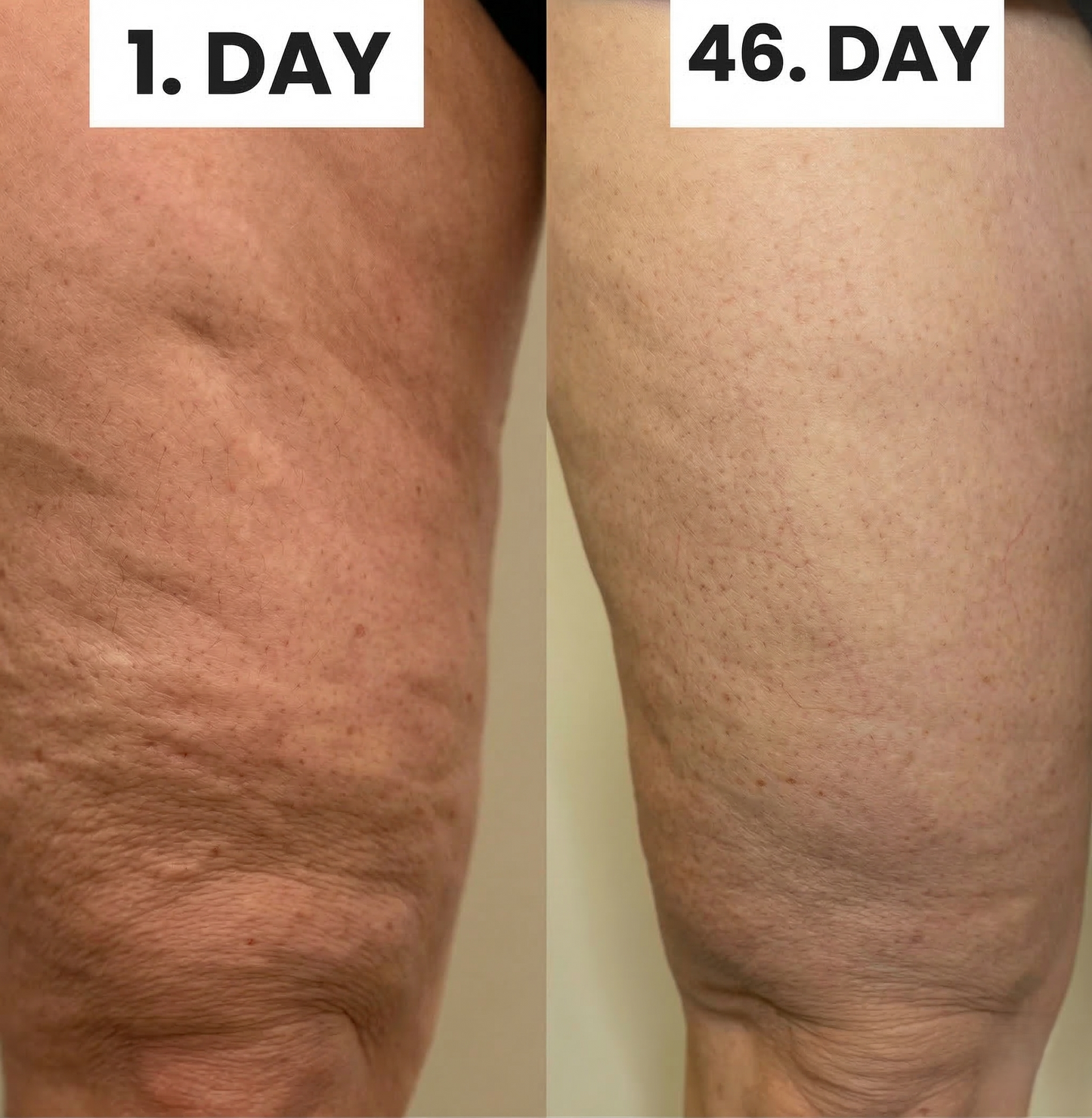 CelluSmooth Pro™