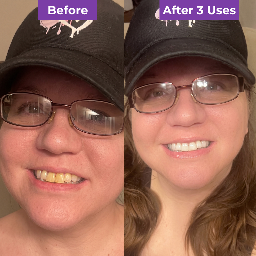 SmileUp Strips™ | Brighter Smile