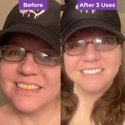 SmileUp Strips™ | Brighter Smile