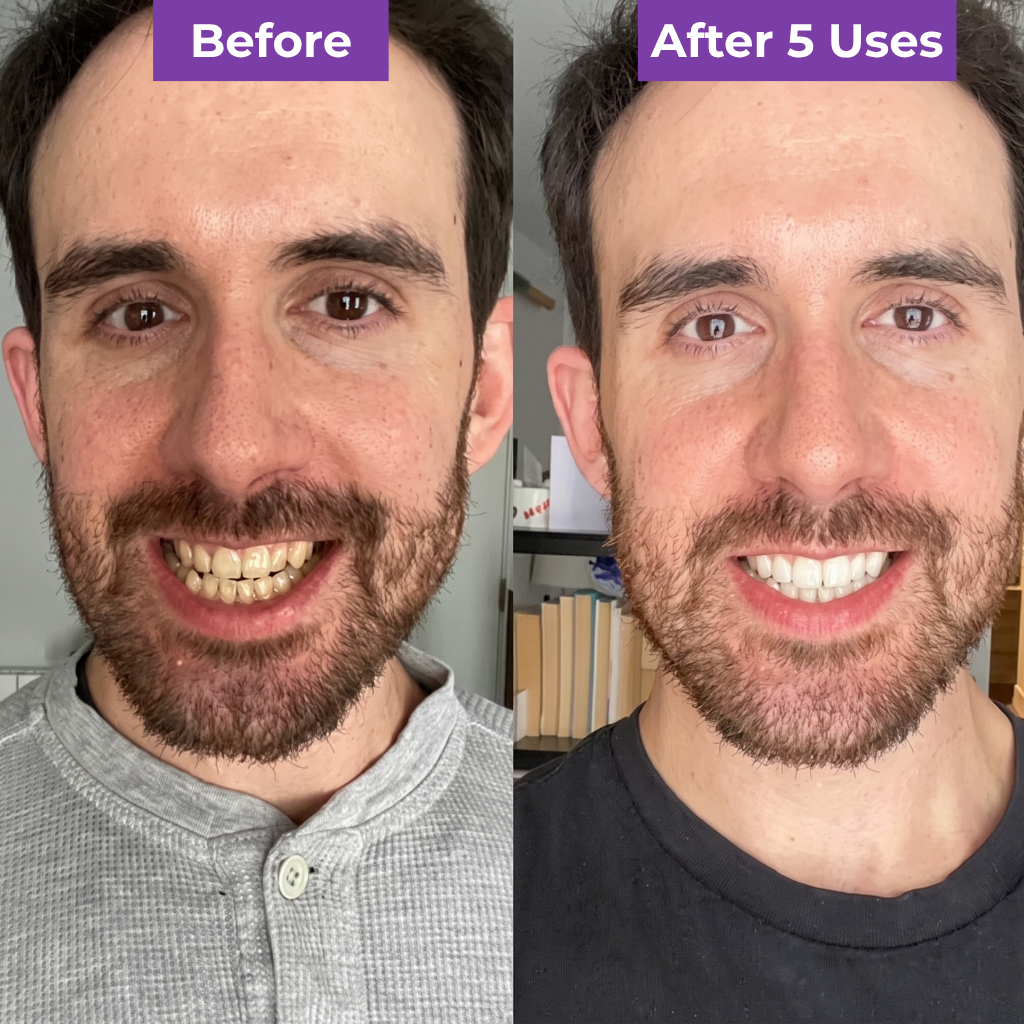 SmileUp Strips™ | Brighter Smile