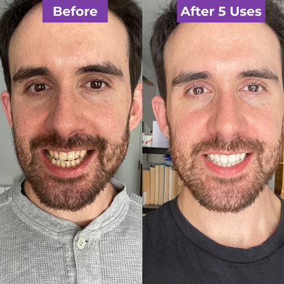 SmileUp Strips™ | Brighter Smile