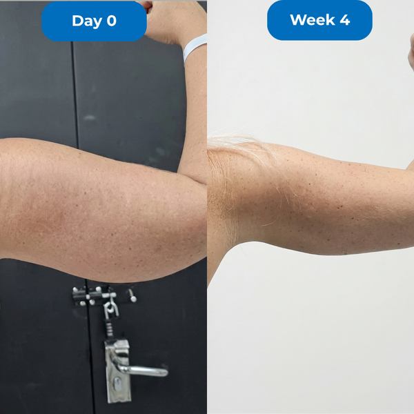 I Stopped Hiding My Arms