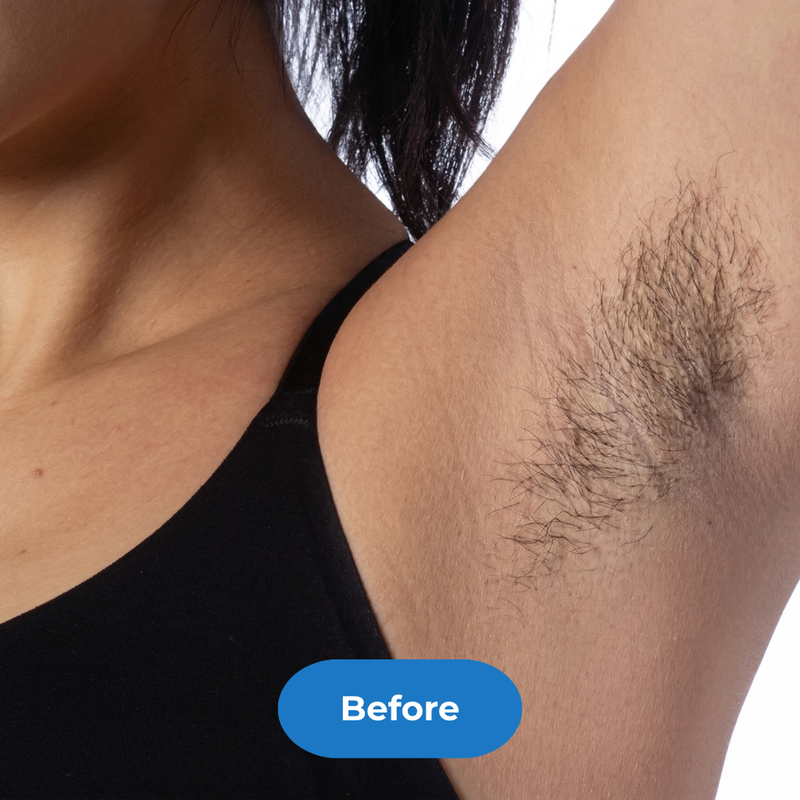 Armpits before treatment