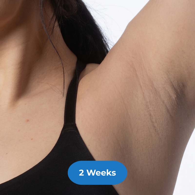 Armpits after treatment