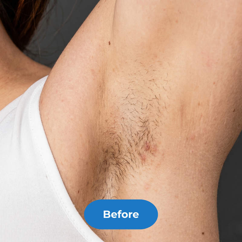 Armpits before treatment