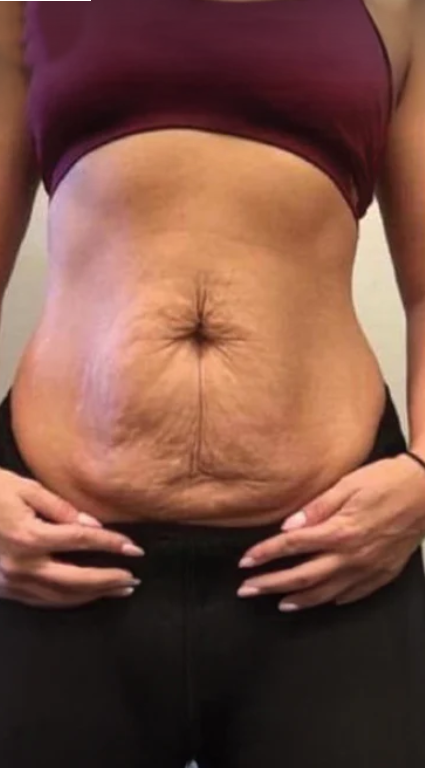 Before - Anna