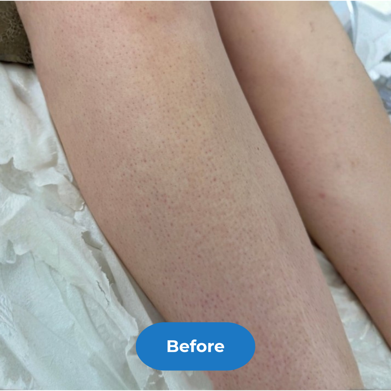 Legs before treatment