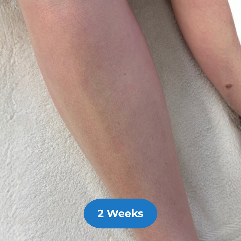 Legs after treatment